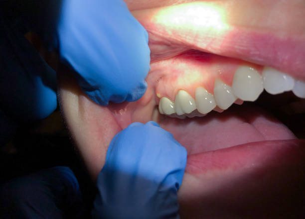 Best Emergency Treatment for Oral Infections in Fargo, ND